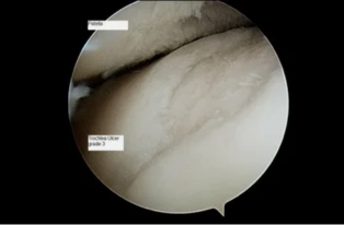 view astroscope on the knee in osteoarthritis of the 3rd degree