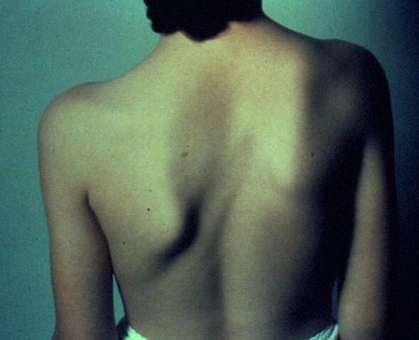 Sprengel's disease as a cause of pain under the left shoulder blade