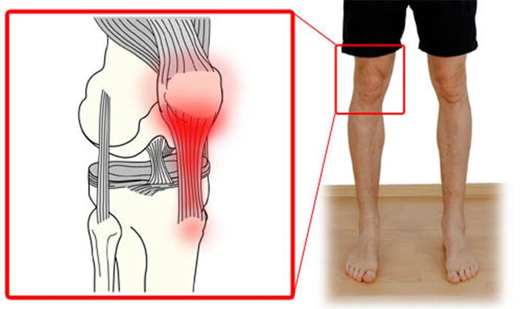 Tendonitis - inflammation of the tendons of the knee joint