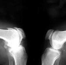 Osteoarthritis on an x-ray