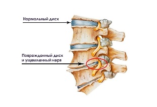 The symptoms of cervical osteoarthritis