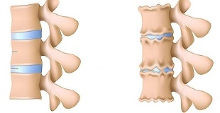 how to recognize the presence of osteochondrosis of the lumbar spine