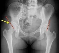 methods of treatment of arthrosis of the hip joint