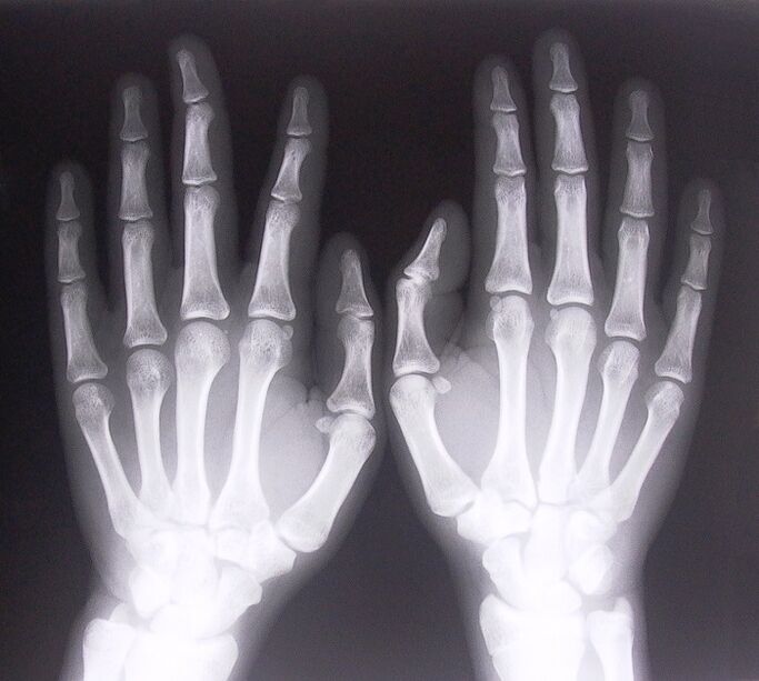 X-rays as a method of diagnosing pain in the joints of the fingers