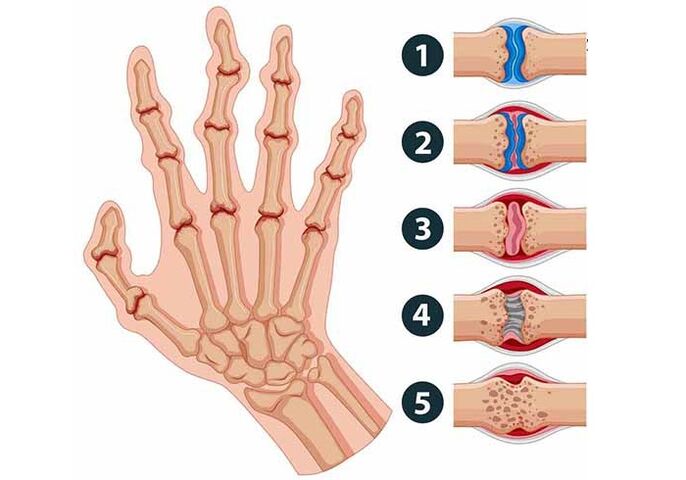 stages of development of arthritis in the joints of the fingers